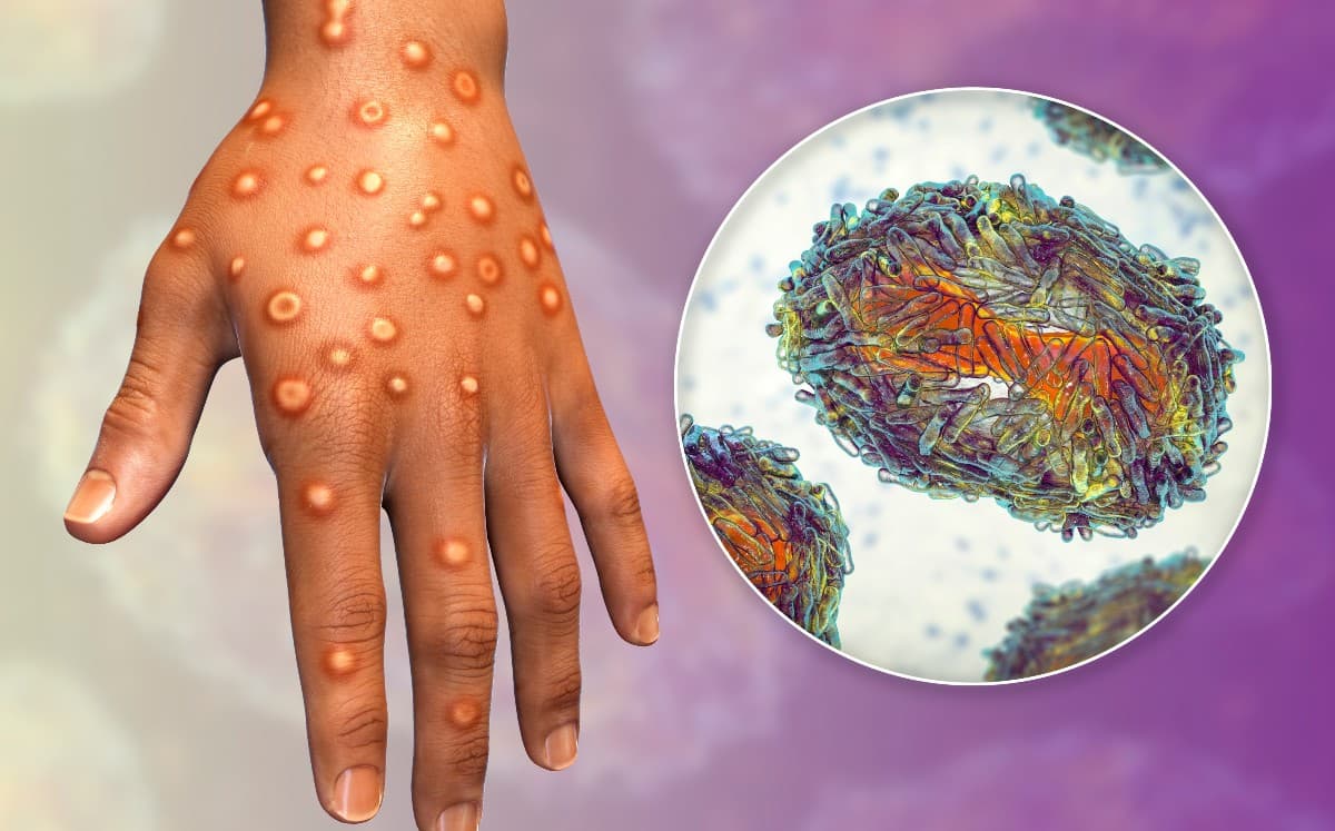 Casos de viruela del mono bajan en el mundo y suben en América