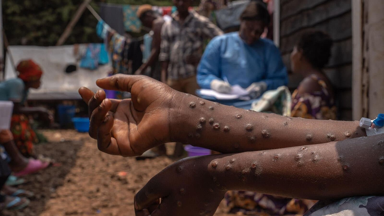 África alcanza los 622 muertos por mpox y espera vacunas