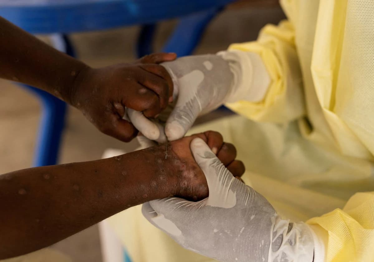 Declaran emergencia sanitaria por brote de viruela del mono