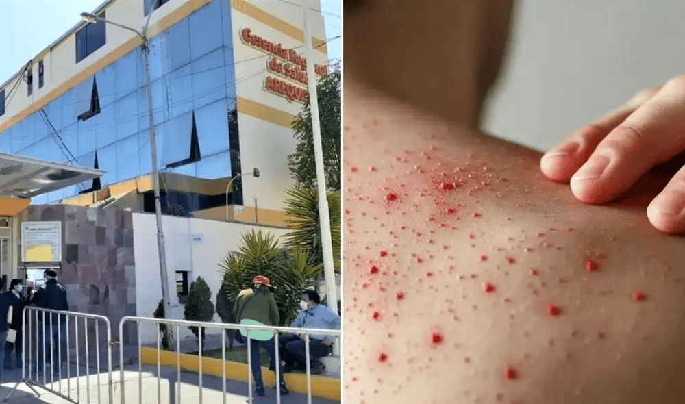 Casos de sarampión suben a 13 en Arequipa