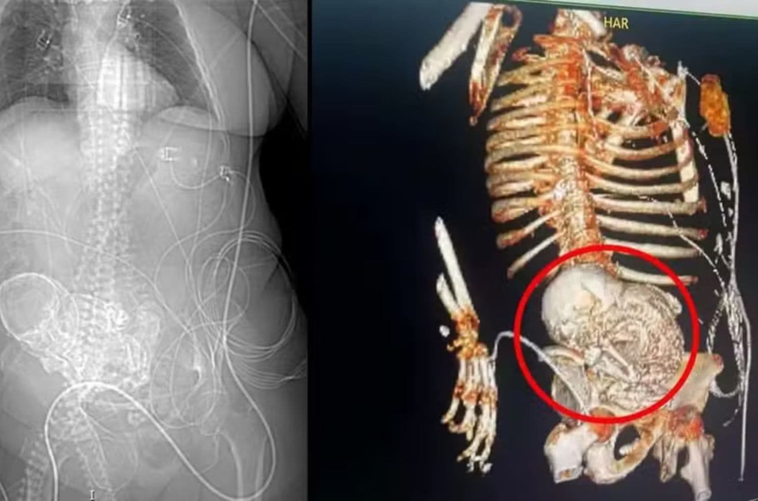 Hallan feto momificado en estómago de mujer